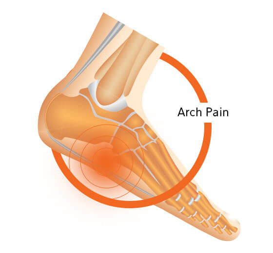 Arch Pain Diagram on Foot