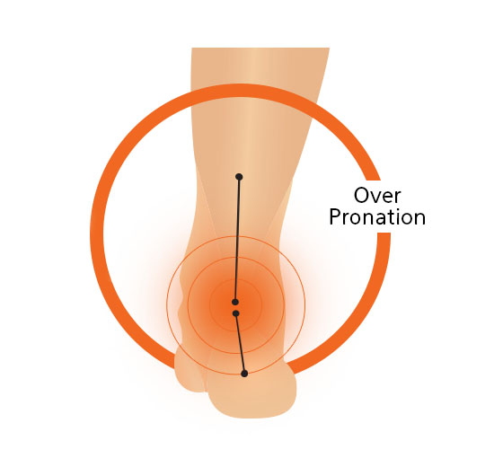 Fallen Arches Foot Diagram Cartoon